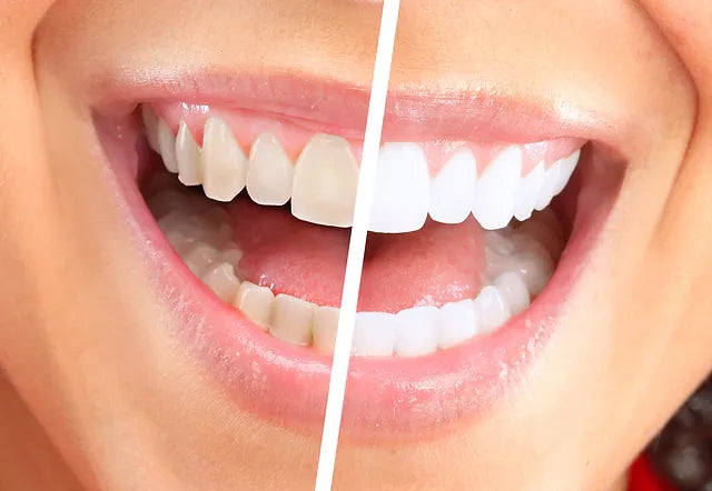 Achieving Optimal Oral Health: Strategies Beyond Teeth Whitening