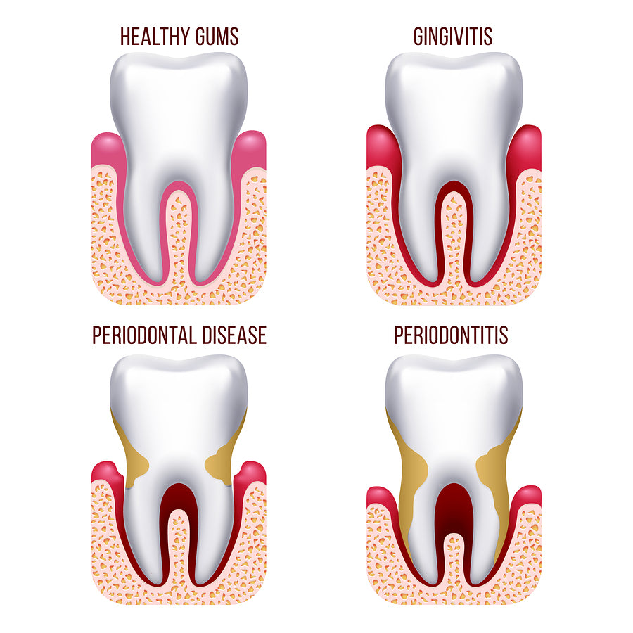 Dental Care: Water Flossers in Periodontal Disease Prevention