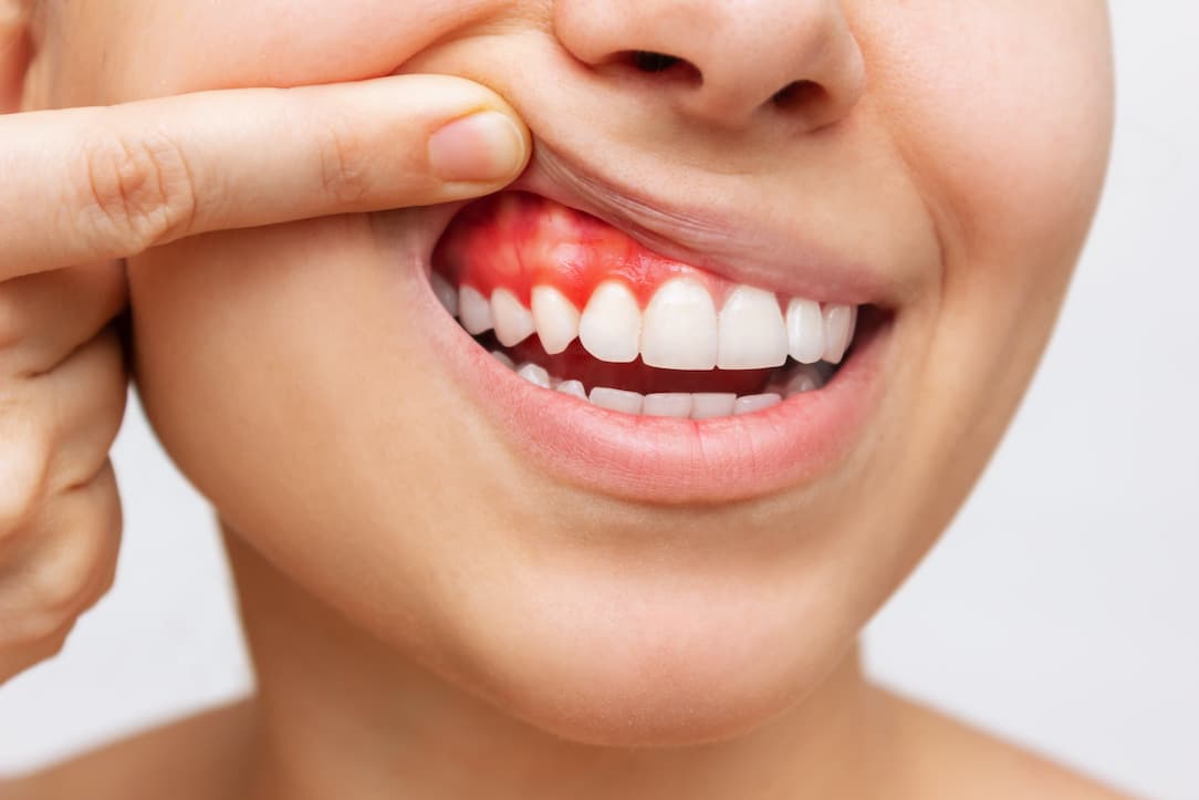 Bleeding Gums: Causes, Solutions, and the Best Implants for Optimal Oral Health
