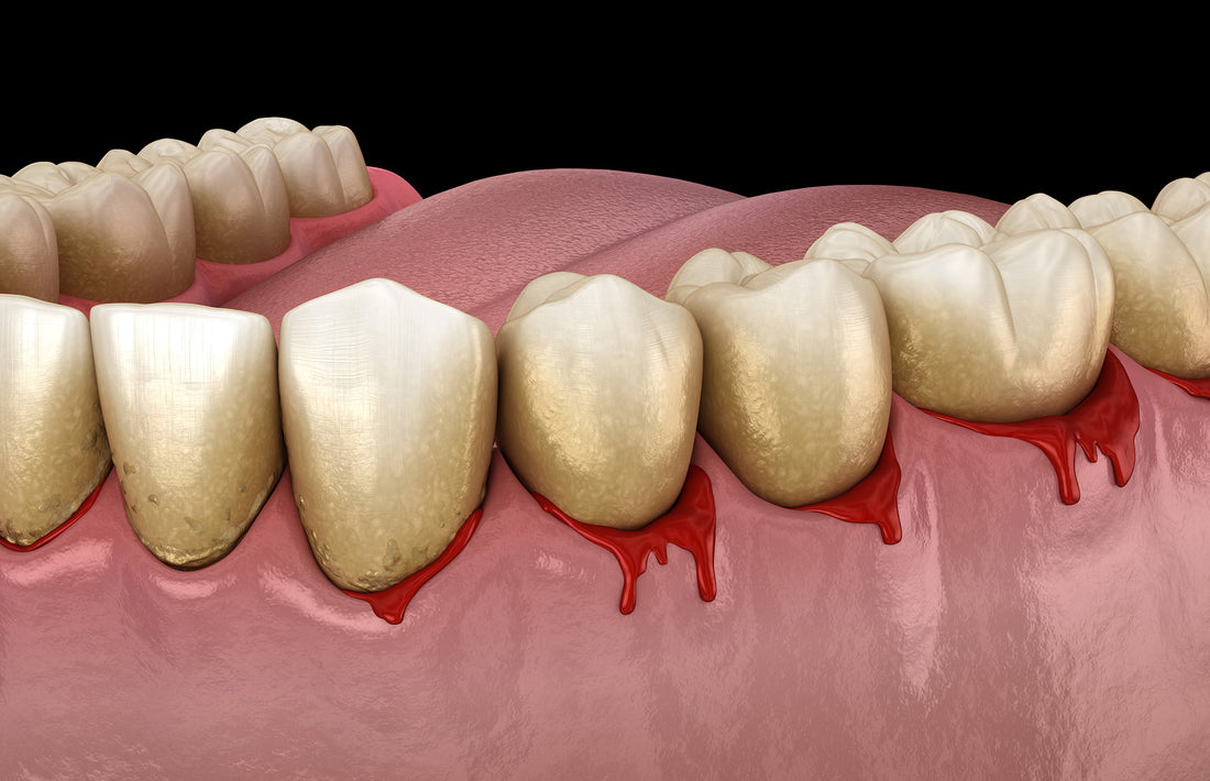 Why Are My Gums Bleeding and How Can I Stop It?