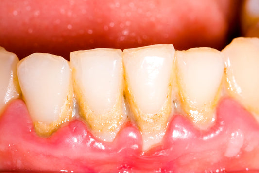 Enhance Your Dental Hygiene with These Tips for Plaque Removal